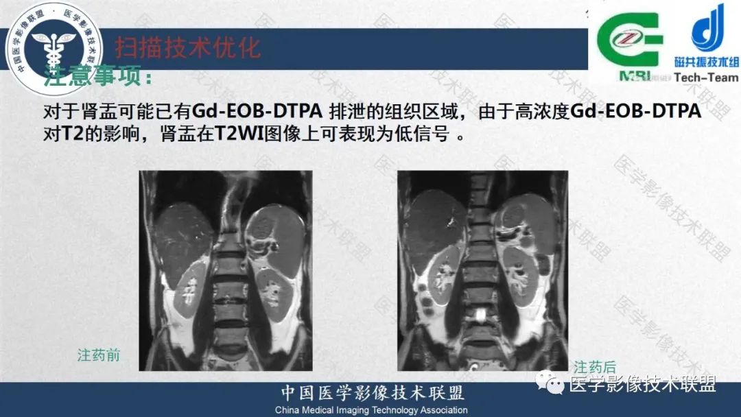 影像PPT - 【PPT】肝脏磁共振规范化扫描特异性对比剂增强MR—扫描方案与经验分享-37
