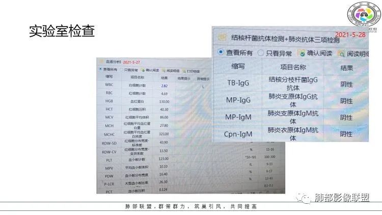 影像PPT - 【病例】出乎意料的“隐球君”,你想到了吗?-4 影像PPT - 【病例】出乎意料的“隐球君”,你想到了吗?-4