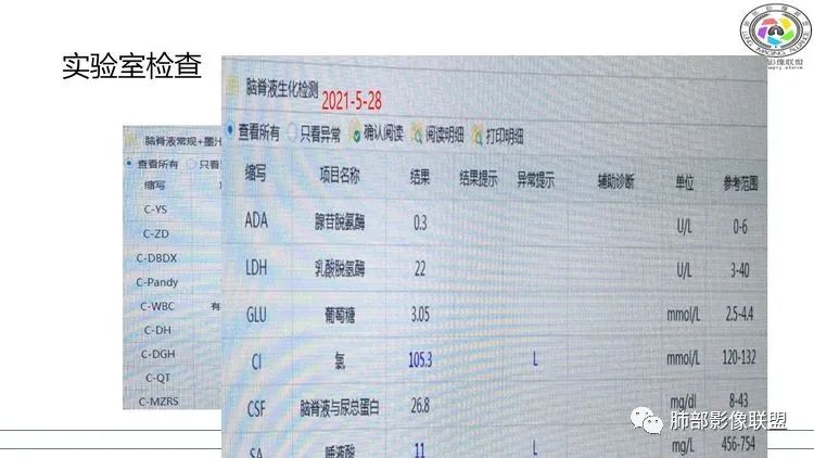影像PPT - 【病例】出乎意料的“隐球君”,你想到了吗?-5 影像PPT - 【病例】出乎意料的“隐球君”,你想到了吗?-5