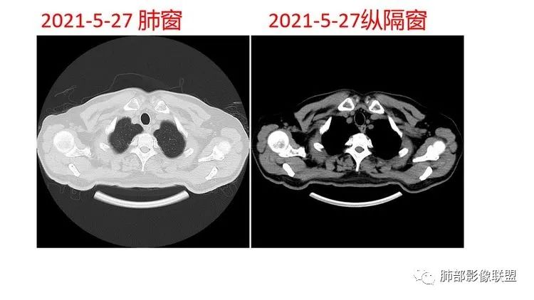 影像PPT - 【病例】出乎意料的“隐球君”,你想到了吗?-9 影像PPT - 【病例】出乎意料的“隐球君”,你想到了吗?-9