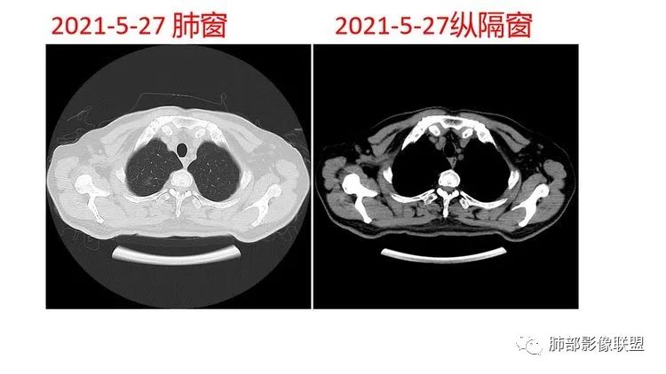 影像PPT - 【病例】出乎意料的“隐球君”,你想到了吗?-11 影像PPT - 【病例】出乎意料的“隐球君”,你想到了吗?-11