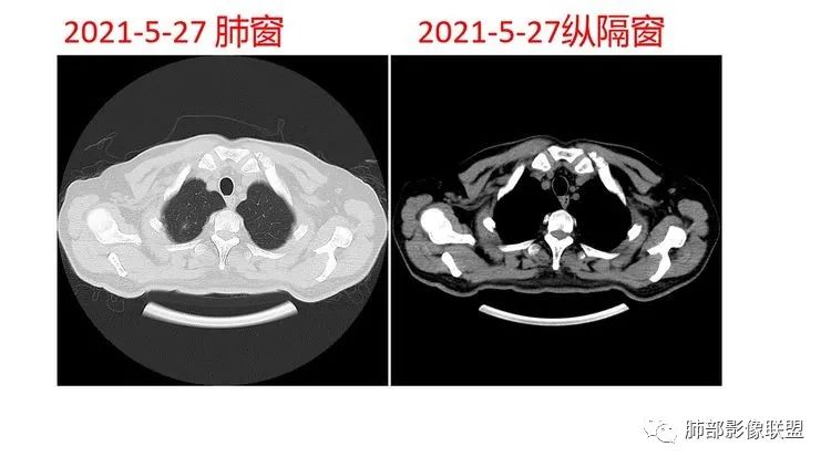 影像PPT - 【病例】出乎意料的“隐球君”,你想到了吗?-10 影像PPT - 【病例】出乎意料的“隐球君”,你想到了吗?-10
