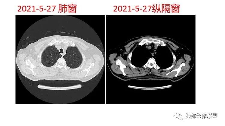 影像PPT - 【病例】出乎意料的“隐球君”,你想到了吗?-12 影像PPT - 【病例】出乎意料的“隐球君”,你想到了吗?-12