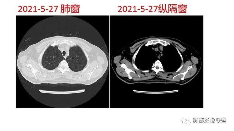 影像PPT - 【病例】出乎意料的“隐球君”,你想到了吗?-13 影像PPT - 【病例】出乎意料的“隐球君”,你想到了吗?-13