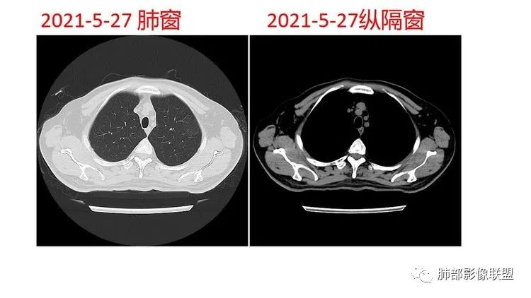 影像PPT - 【病例】出乎意料的“隐球君”,你想到了吗?-14 影像PPT - 【病例】出乎意料的“隐球君”,你想到了吗?-14