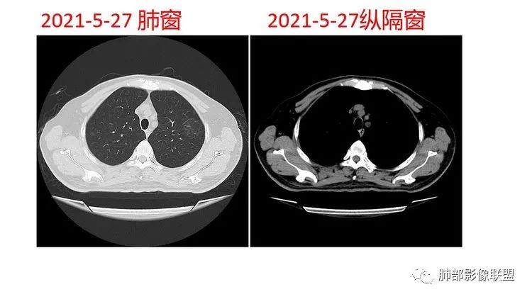 影像PPT - 【病例】出乎意料的“隐球君”,你想到了吗?-16 影像PPT - 【病例】出乎意料的“隐球君”,你想到了吗?-16