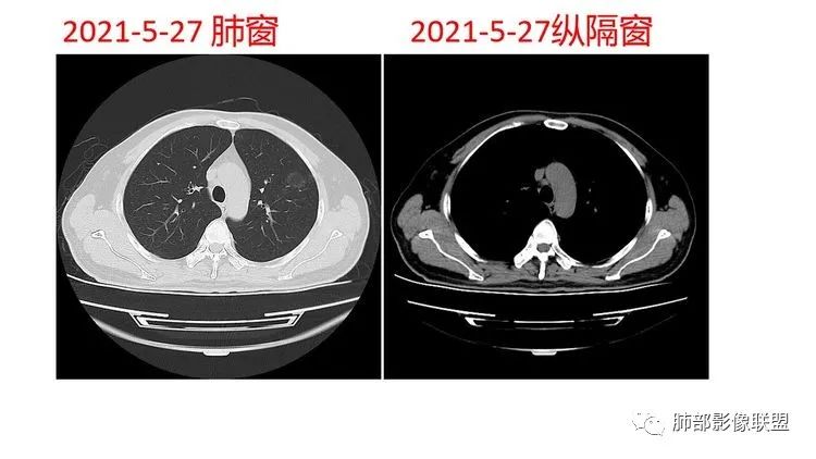 影像PPT - 【病例】出乎意料的“隐球君”,你想到了吗?-20 影像PPT - 【病例】出乎意料的“隐球君”,你想到了吗?-20