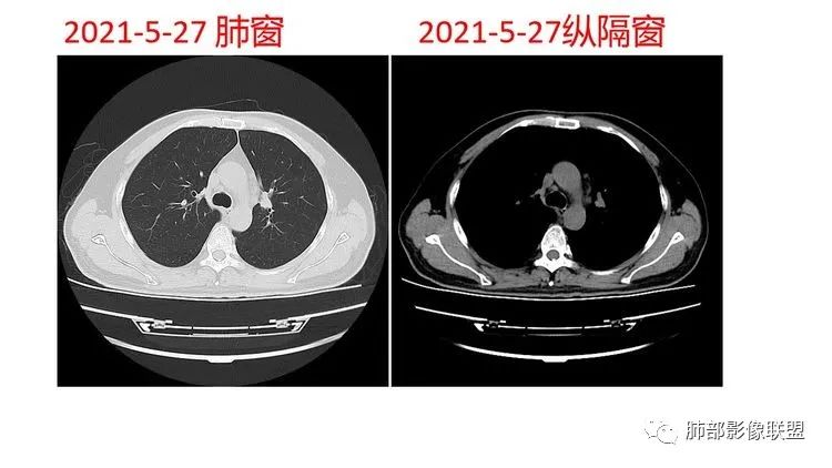 影像PPT - 【病例】出乎意料的“隐球君”,你想到了吗?-22 影像PPT - 【病例】出乎意料的“隐球君”,你想到了吗?-22