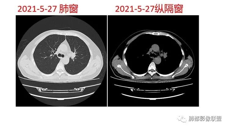 影像PPT - 【病例】出乎意料的“隐球君”,你想到了吗?-23 影像PPT - 【病例】出乎意料的“隐球君”,你想到了吗?-23