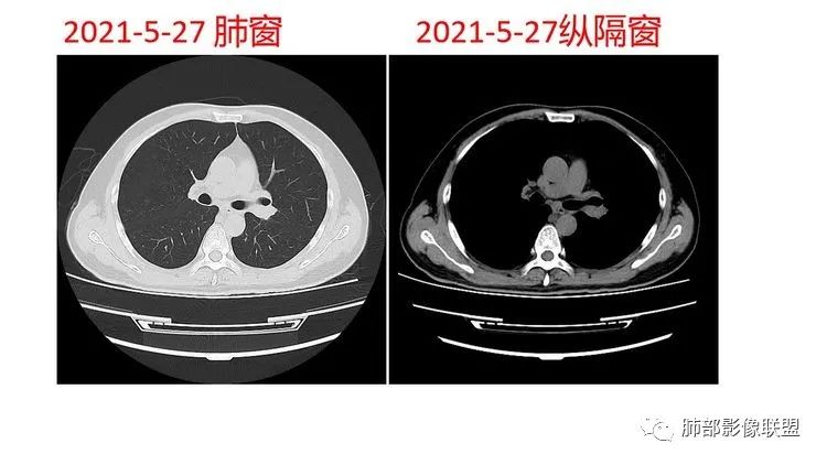 影像PPT - 【病例】出乎意料的“隐球君”,你想到了吗?-26 影像PPT - 【病例】出乎意料的“隐球君”,你想到了吗?-26