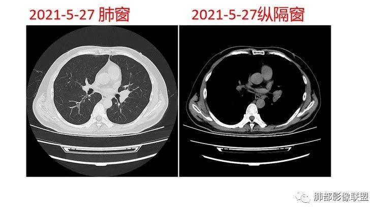 影像PPT - 【病例】出乎意料的“隐球君”,你想到了吗?-29 影像PPT - 【病例】出乎意料的“隐球君”,你想到了吗?-29