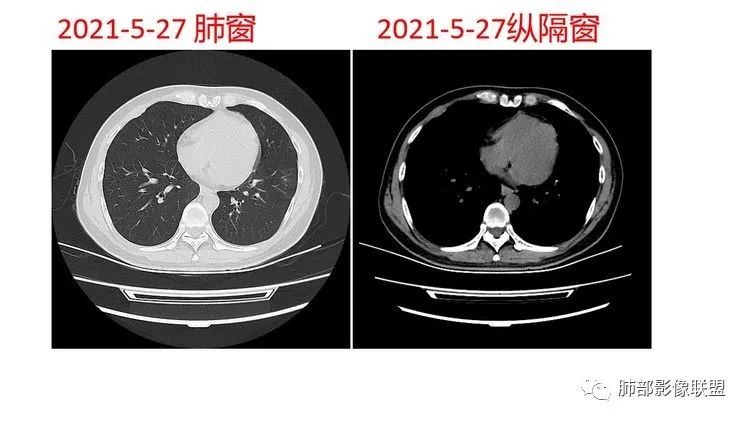 影像PPT - 【病例】出乎意料的“隐球君”,你想到了吗?-38 影像PPT - 【病例】出乎意料的“隐球君”,你想到了吗?-38