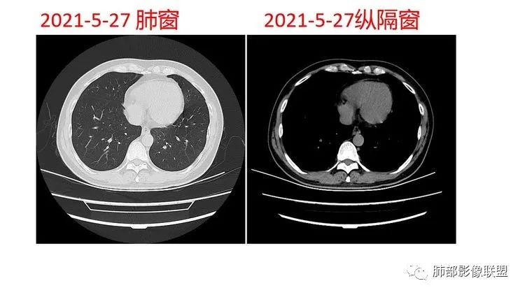 影像PPT - 【病例】出乎意料的“隐球君”,你想到了吗?-42 影像PPT - 【病例】出乎意料的“隐球君”,你想到了吗?-42