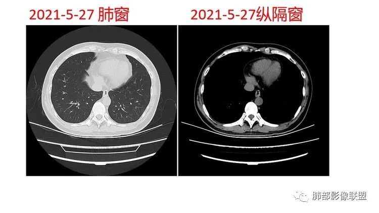 影像PPT - 【病例】出乎意料的“隐球君”,你想到了吗?-44 影像PPT - 【病例】出乎意料的“隐球君”,你想到了吗?-44
