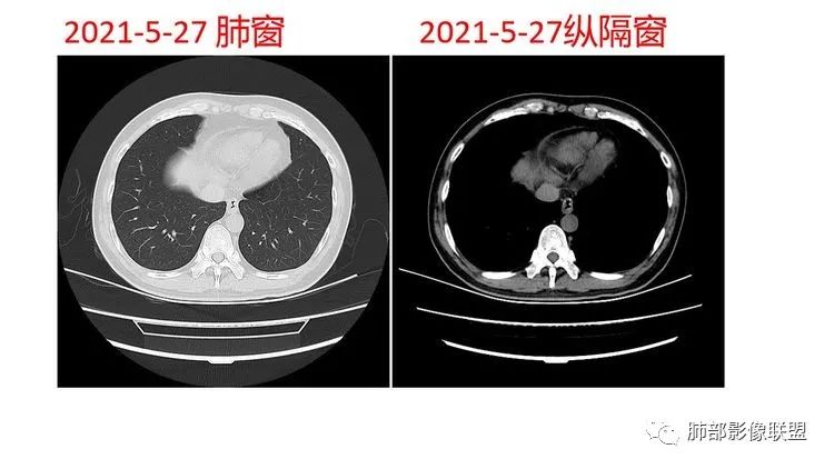 影像PPT - 【病例】出乎意料的“隐球君”,你想到了吗?-45 影像PPT - 【病例】出乎意料的“隐球君”,你想到了吗?-45