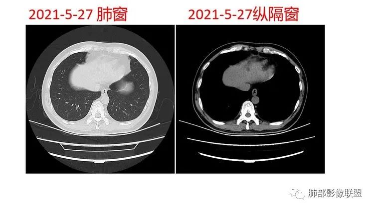 影像PPT - 【病例】出乎意料的“隐球君”,你想到了吗?-46 影像PPT - 【病例】出乎意料的“隐球君”,你想到了吗?-46