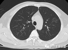 影像PPT - 【病例】出乎意料的“隐球君”,你想到了吗?-71 影像PPT - 【病例】出乎意料的“隐球君”,你想到了吗?-71