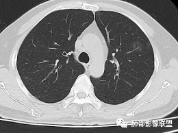 影像PPT - 【病例】出乎意料的“隐球君”,你想到了吗?-73 影像PPT - 【病例】出乎意料的“隐球君”,你想到了吗?-73