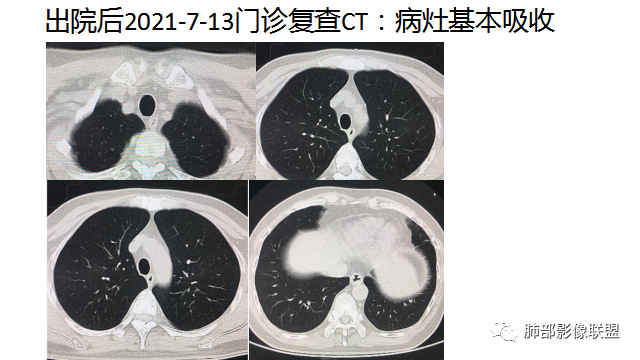 影像PPT - 【病例】出乎意料的“隐球君”,你想到了吗?-80 影像PPT - 【病例】出乎意料的“隐球君”,你想到了吗?-80
