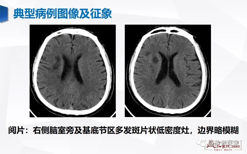 影像PPT - 【PPT】脑血管病（脑梗死及各期演变）-4