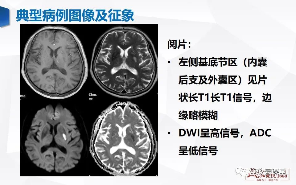 影像PPT - 【PPT】脑血管病（脑梗死及各期演变）-6