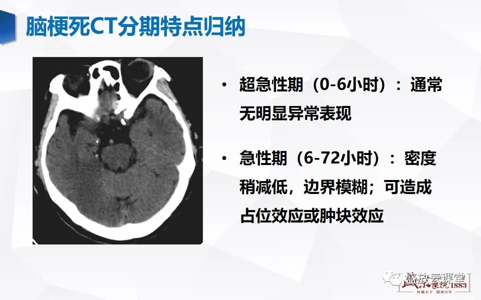 影像PPT - 【PPT】脑血管病（脑梗死及各期演变）-17
