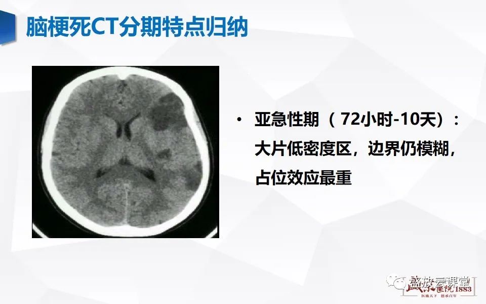 影像PPT - 【PPT】脑血管病（脑梗死及各期演变）-18