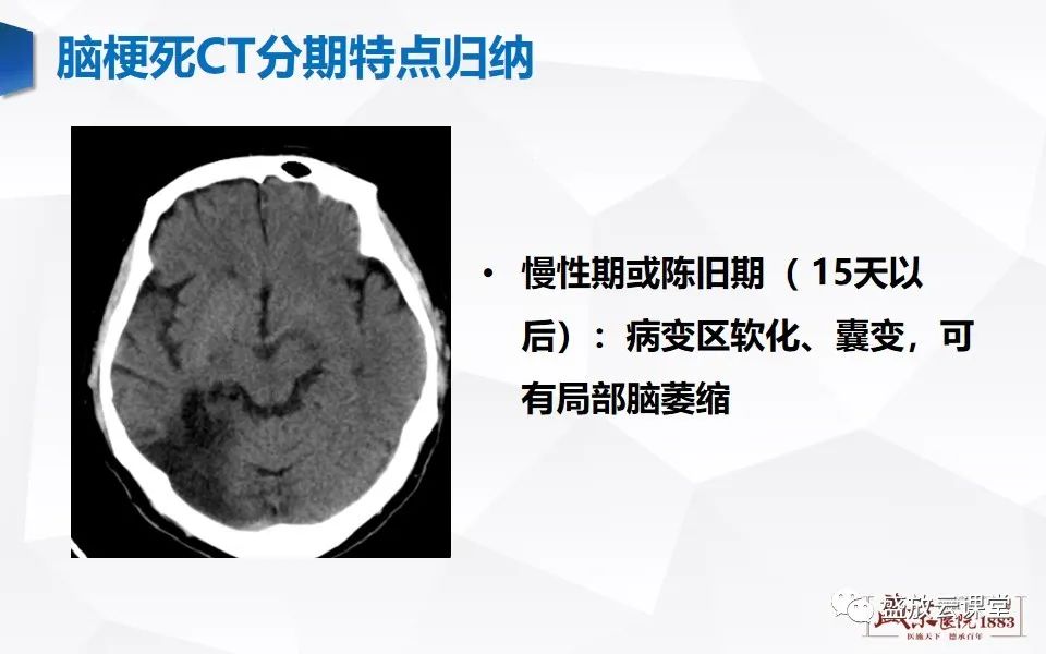 影像PPT - 【PPT】脑血管病（脑梗死及各期演变）-20
