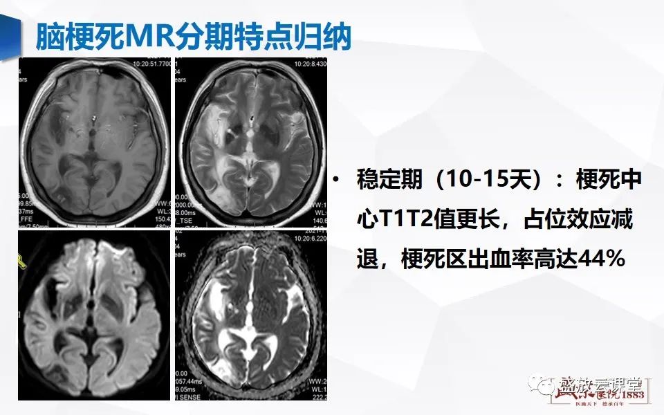 影像PPT - 【PPT】脑血管病（脑梗死及各期演变）-23