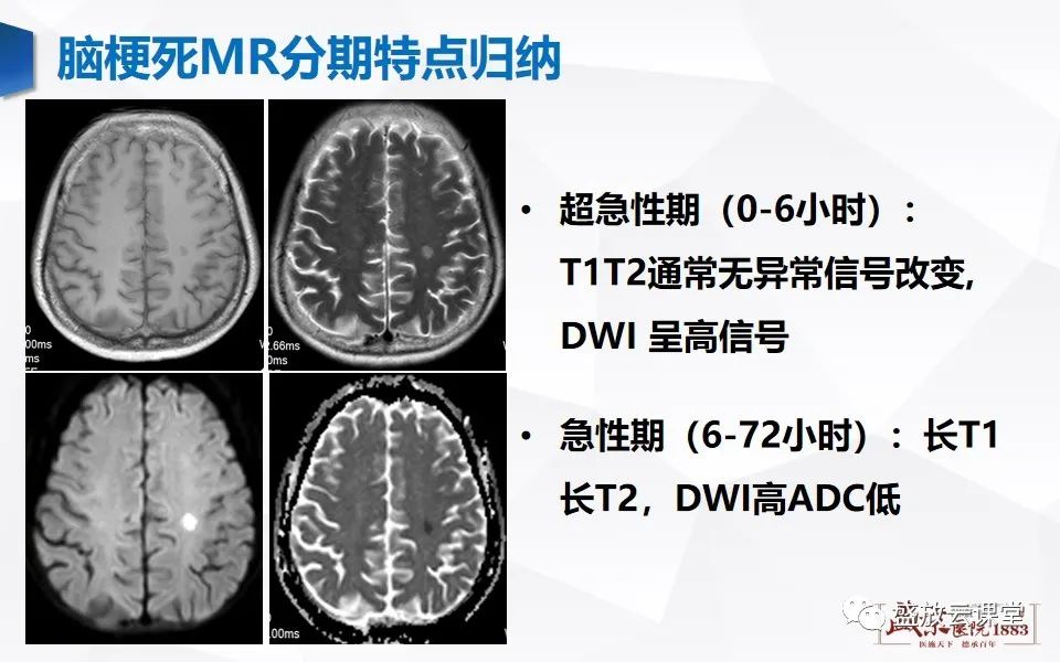 影像PPT - 【PPT】脑血管病（脑梗死及各期演变）-21