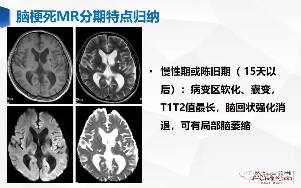 影像PPT - 【PPT】脑血管病（脑梗死及各期演变）-24