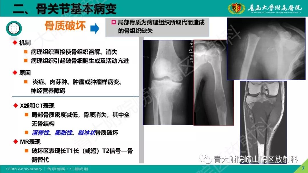 影像PPT - 【PPT】骨关节影像诊断培训要点解析-7