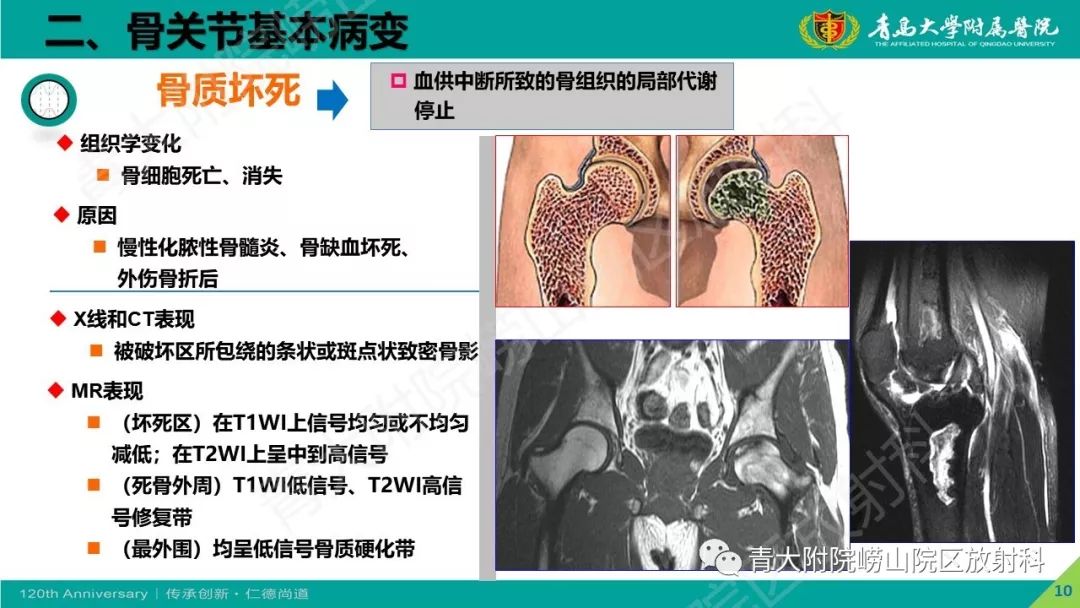 影像PPT - 【PPT】骨关节影像诊断培训要点解析-10