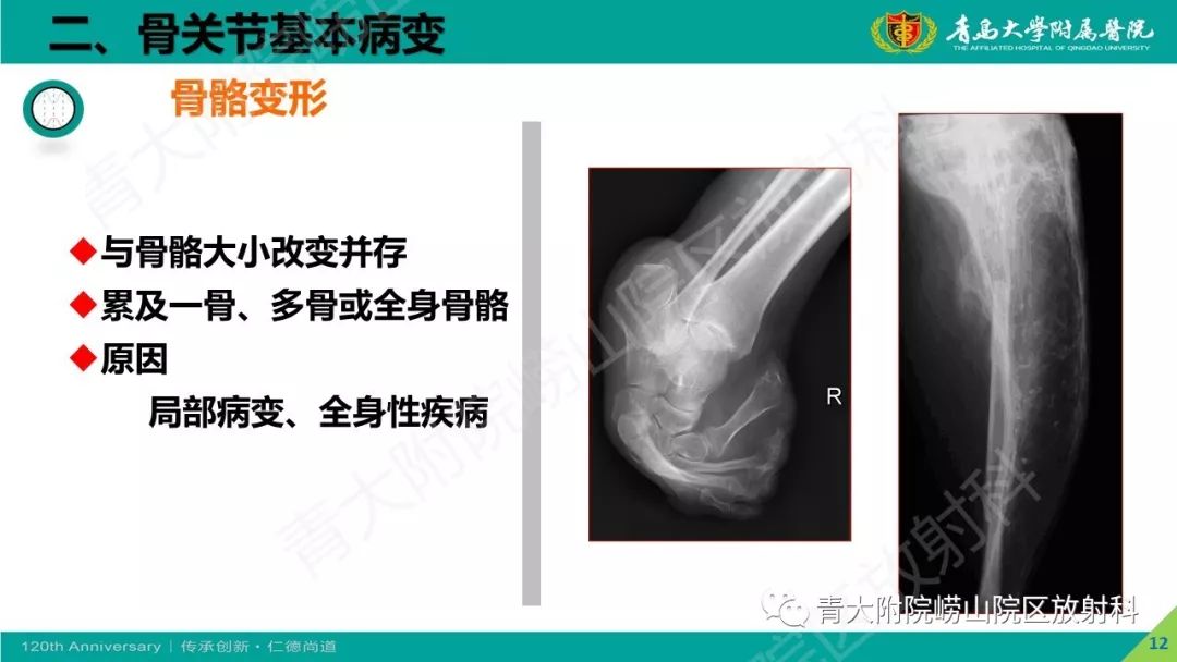 影像PPT - 【PPT】骨关节影像诊断培训要点解析-12
