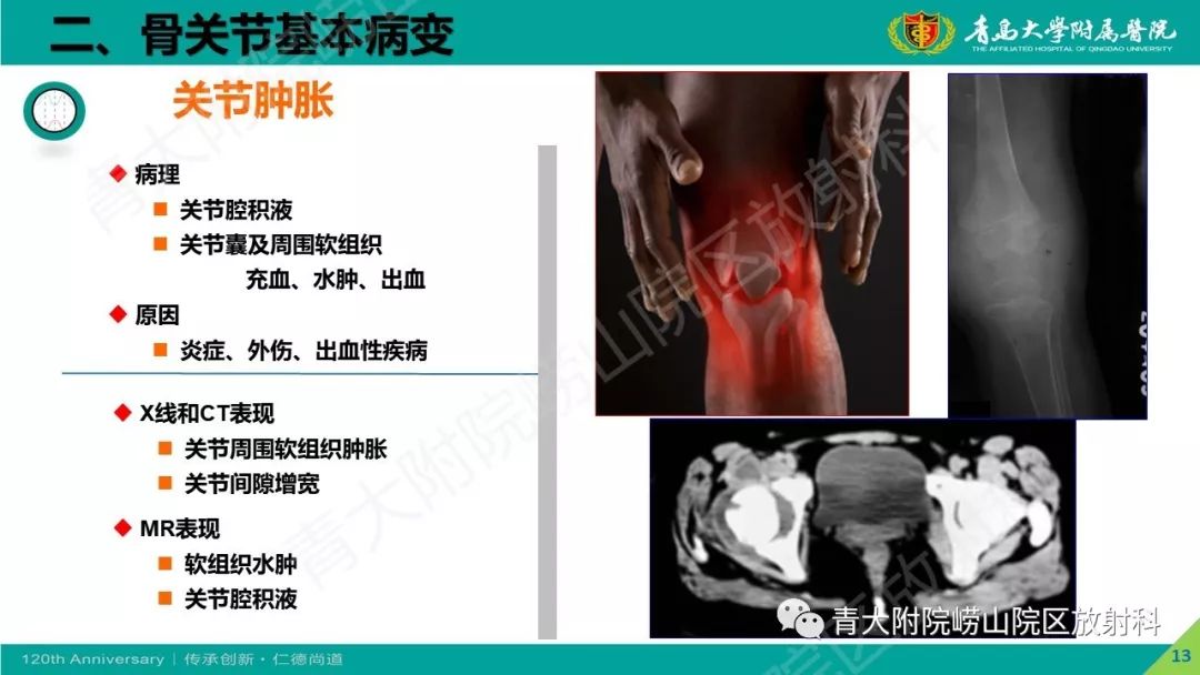 影像PPT - 【PPT】骨关节影像诊断培训要点解析-13