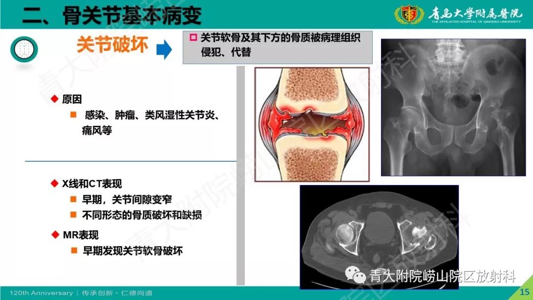 影像PPT - 【PPT】骨关节影像诊断培训要点解析-15