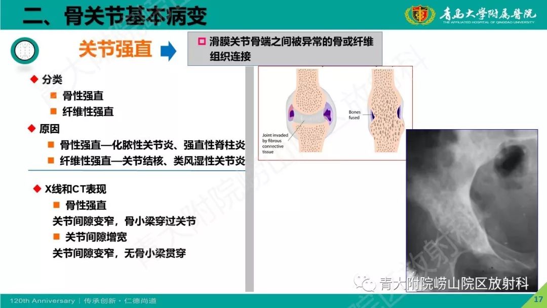 影像PPT - 【PPT】骨关节影像诊断培训要点解析-17