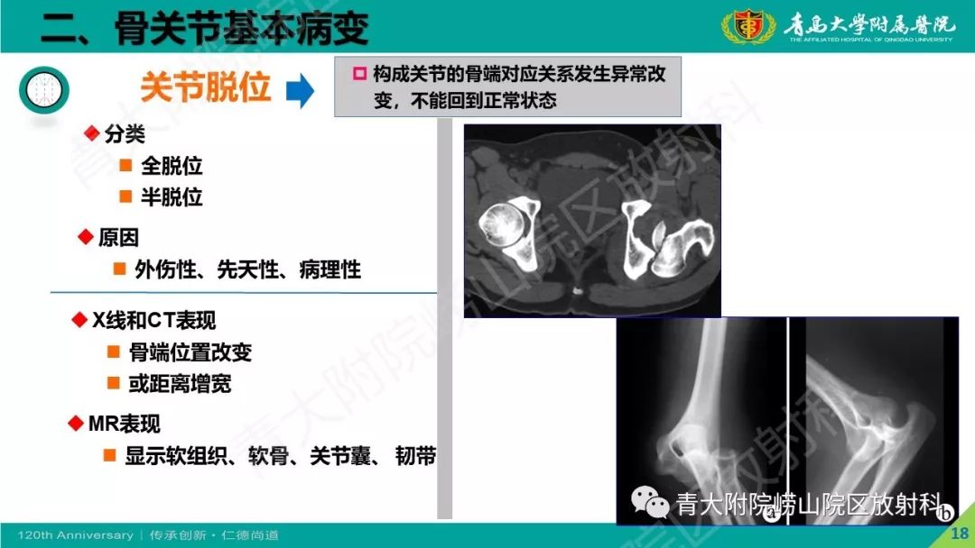 影像PPT - 【PPT】骨关节影像诊断培训要点解析-18