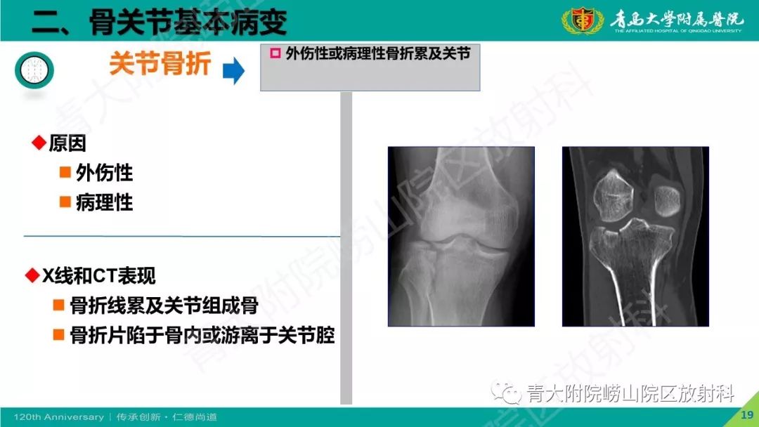 影像PPT - 【PPT】骨关节影像诊断培训要点解析-19