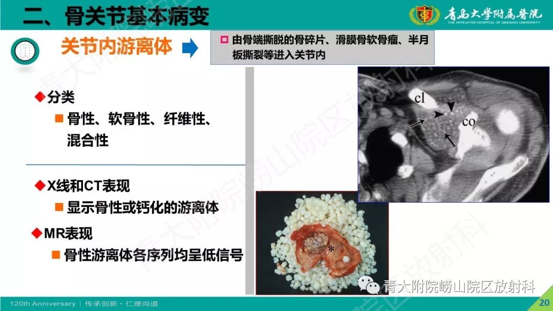 影像PPT - 【PPT】骨关节影像诊断培训要点解析-20