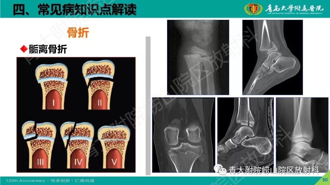 影像PPT - 【PPT】骨关节影像诊断培训要点解析-30