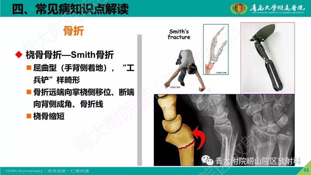 影像PPT - 【PPT】骨关节影像诊断培训要点解析-33
