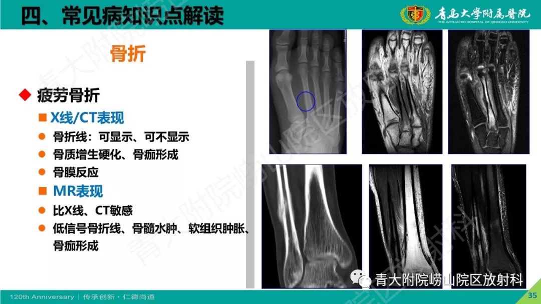 影像PPT - 【PPT】骨关节影像诊断培训要点解析-35