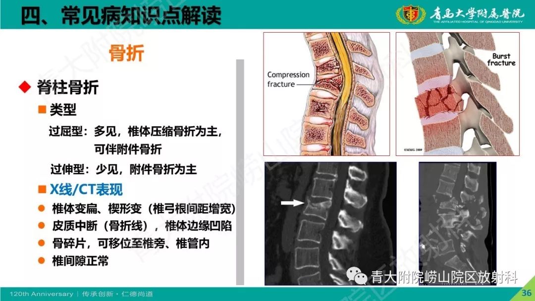 影像PPT - 【PPT】骨关节影像诊断培训要点解析-36