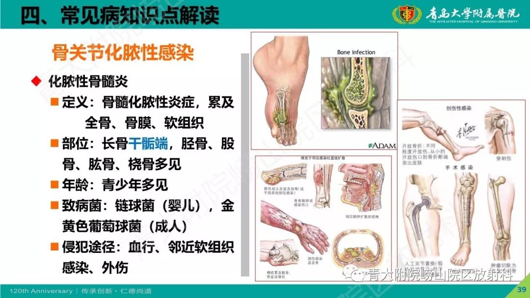 影像PPT - 【PPT】骨关节影像诊断培训要点解析-39