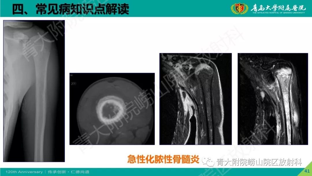 影像PPT - 【PPT】骨关节影像诊断培训要点解析-41