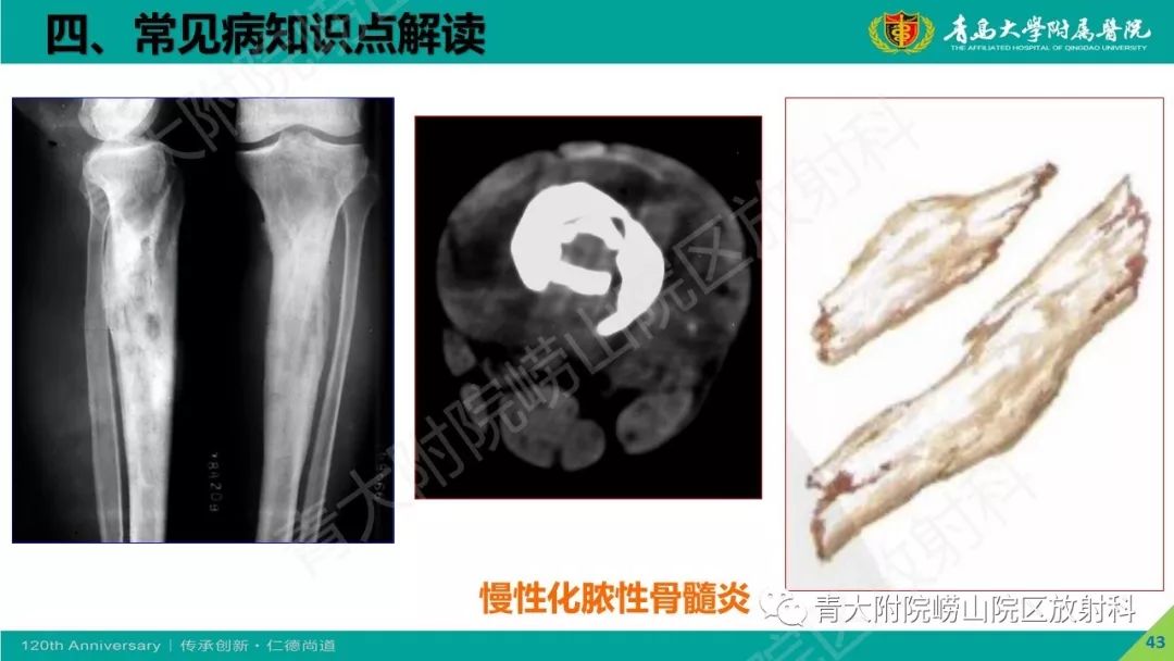 影像PPT - 【PPT】骨关节影像诊断培训要点解析-43