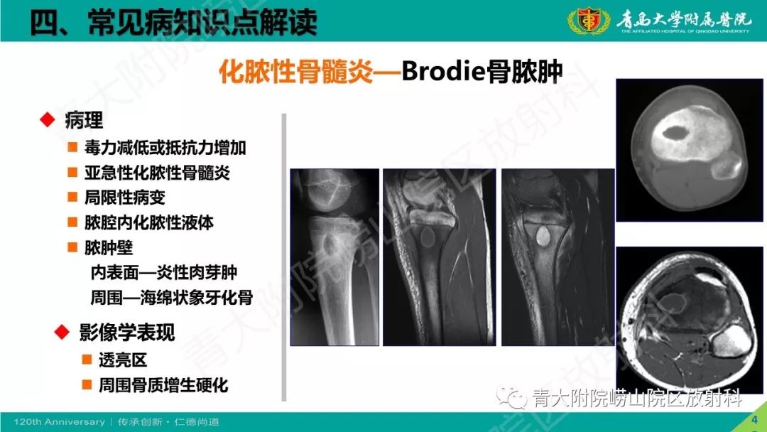 影像PPT - 【PPT】骨关节影像诊断培训要点解析-45