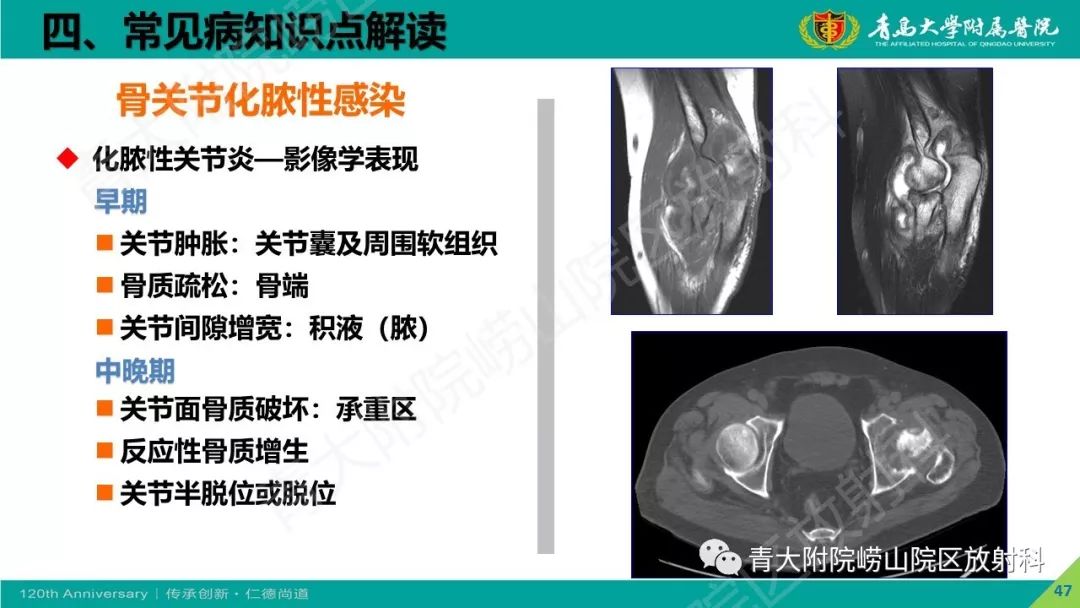 影像PPT - 【PPT】骨关节影像诊断培训要点解析-47