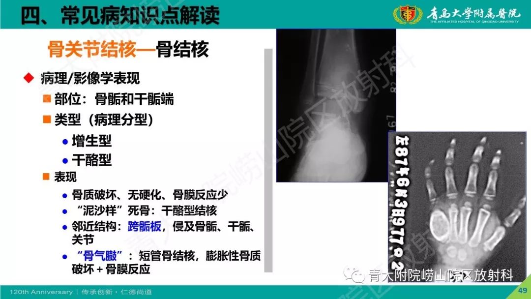 影像PPT - 【PPT】骨关节影像诊断培训要点解析-49